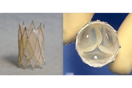 The Iris Valve, a transcatheter, growth-accommodating pulmonary valve designed for very young children, was developed at UC Irvine and is currently progressing toward FDA clinical approval. Arash Kheradvar
